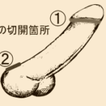 修正でメスを入れる場所
